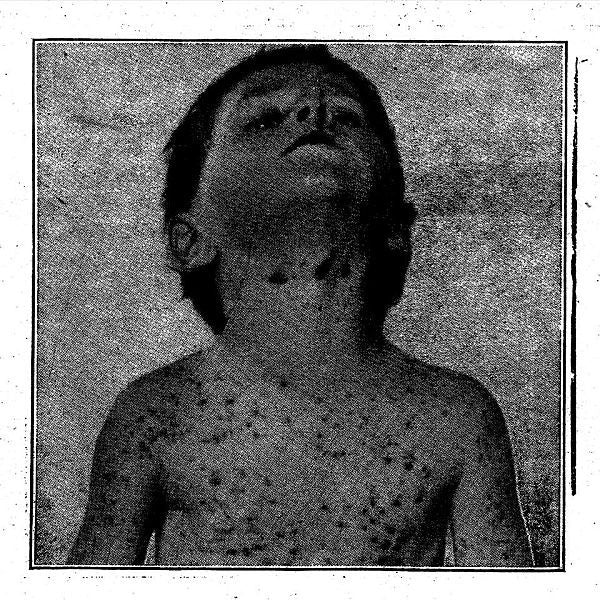 Rectal Hygienics - Even The Flies Won't Touch You - Vintage 2013 USA Rock Lo-Fi Punk Vinyl LP Record with Insert and Screen - Printed Cover